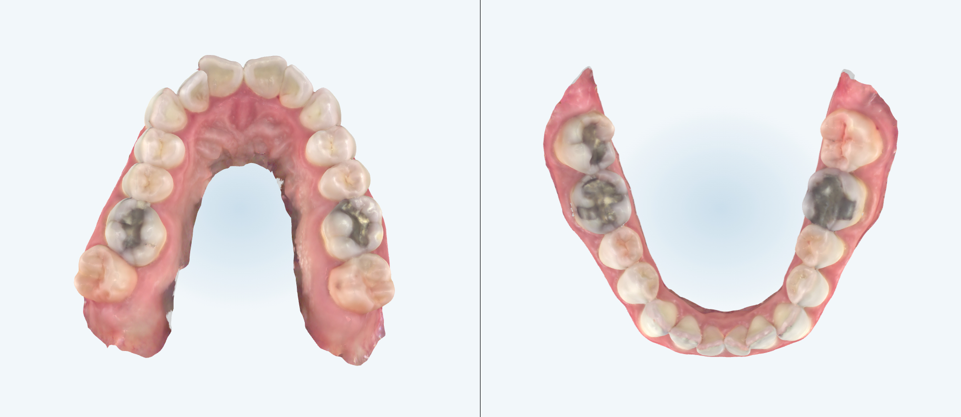 Dental expansion treatment comparison case 1 before